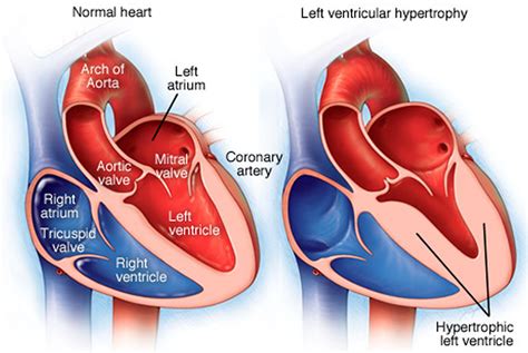 mild eccentric left ventricular hypertrophy.